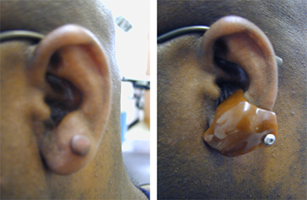 Keloid on ear